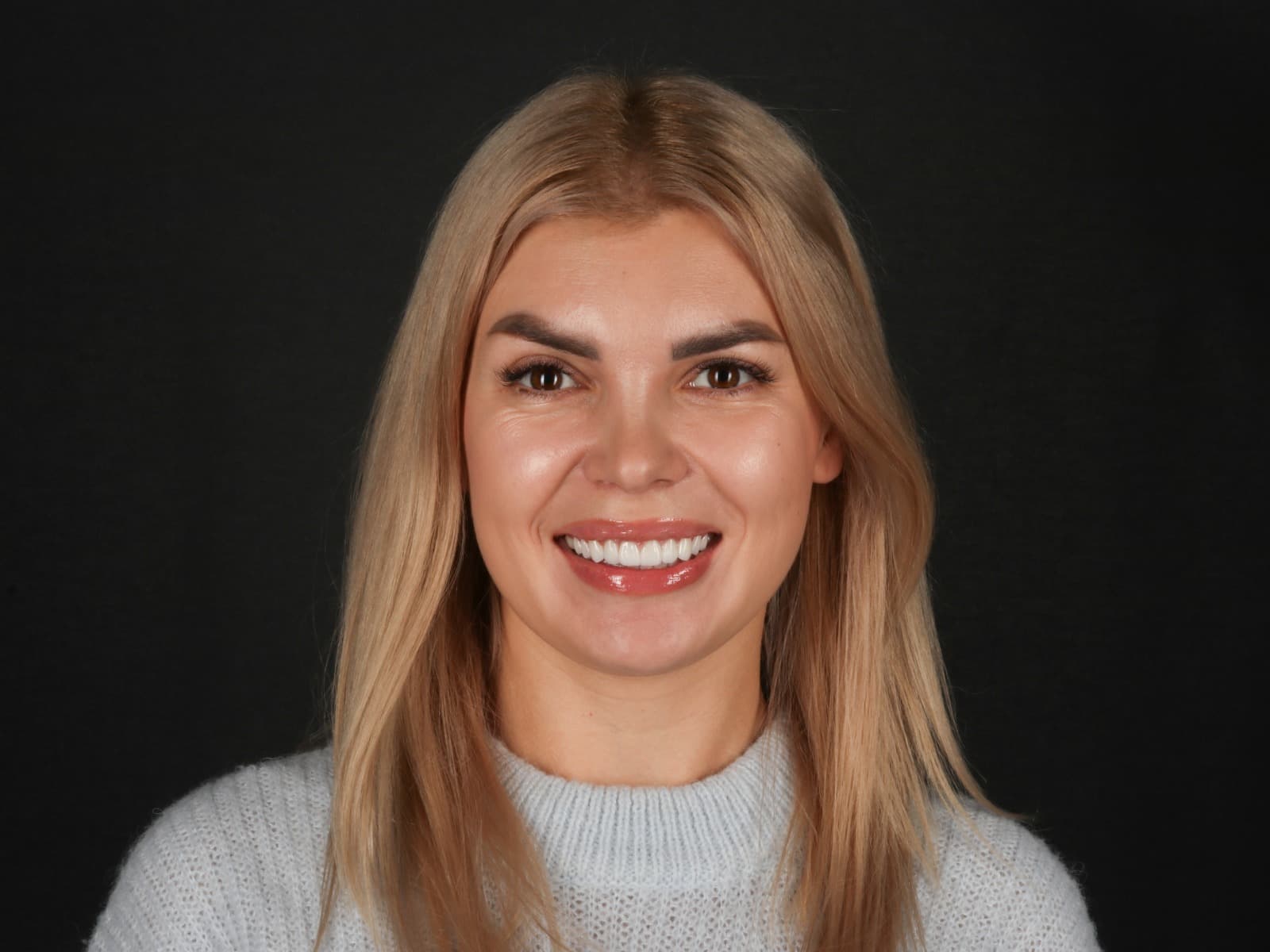 Veneer Smile Makeover with Digital Design