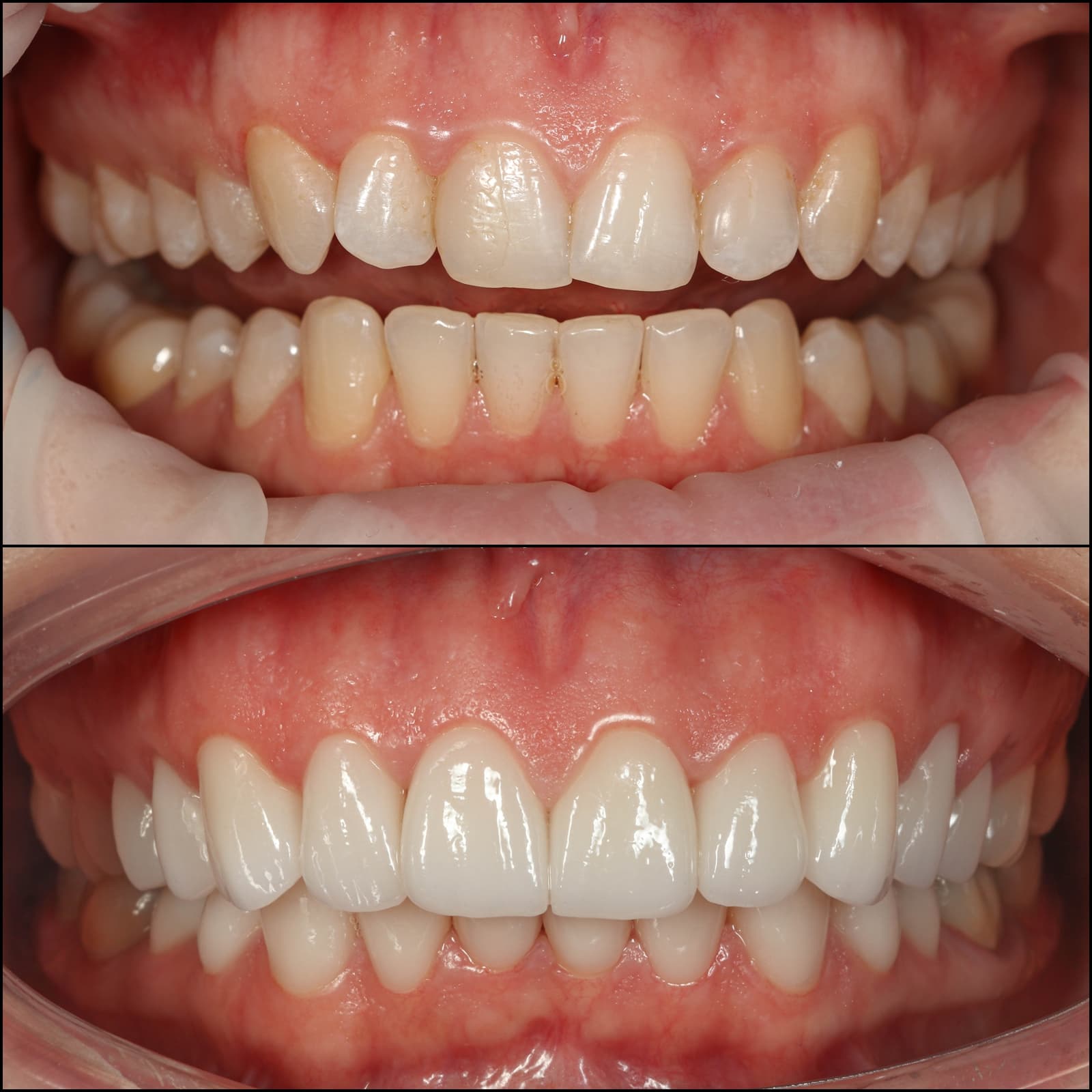 Before - Veneer Smile Makeover with Digital Design