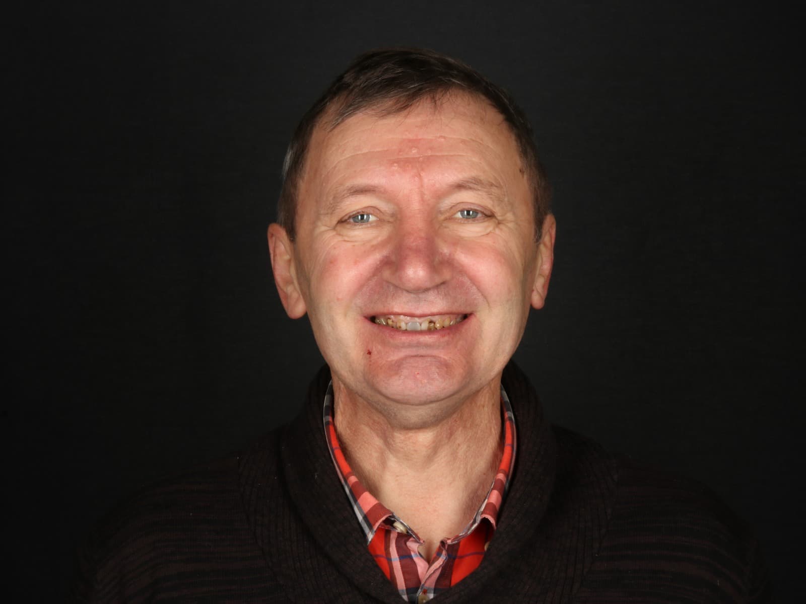 Before - The Total Smile Rebirth: From Gummy Smile to Lifelike Confidence