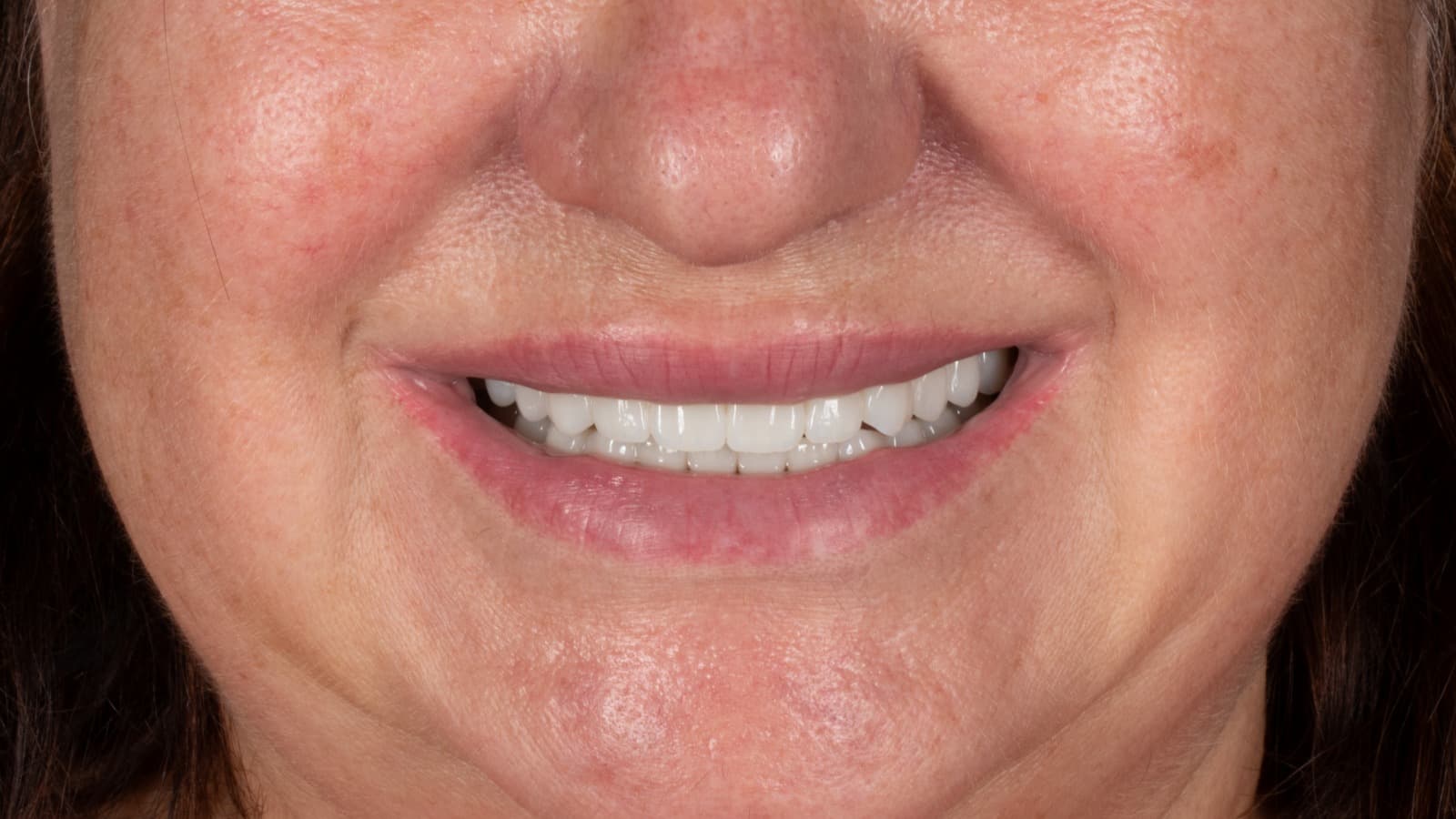 The Total Smile Refresh: Beyond Fillings to Lasting Artistry