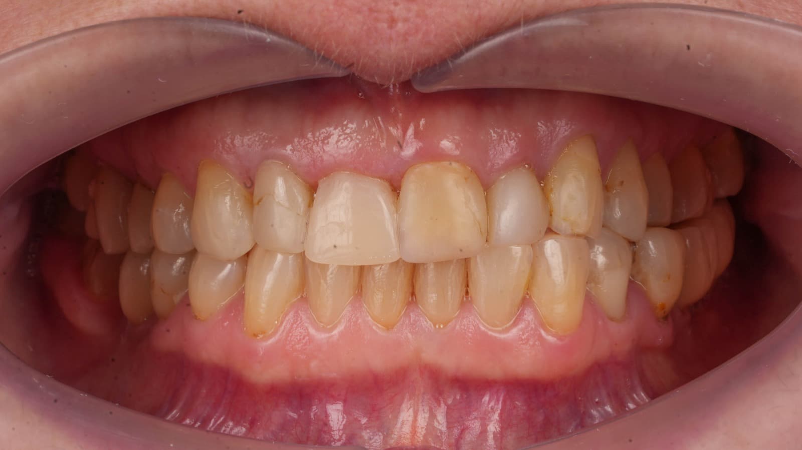 Before - The Total Smile Refresh: Beyond Fillings to Lasting Artistry