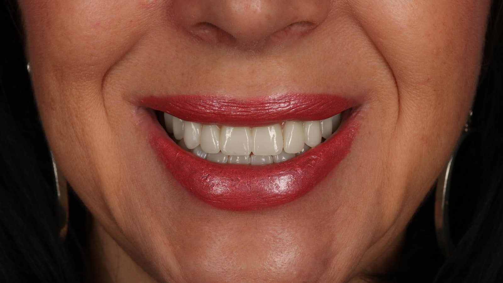 Dental implants before & after: real patient cases