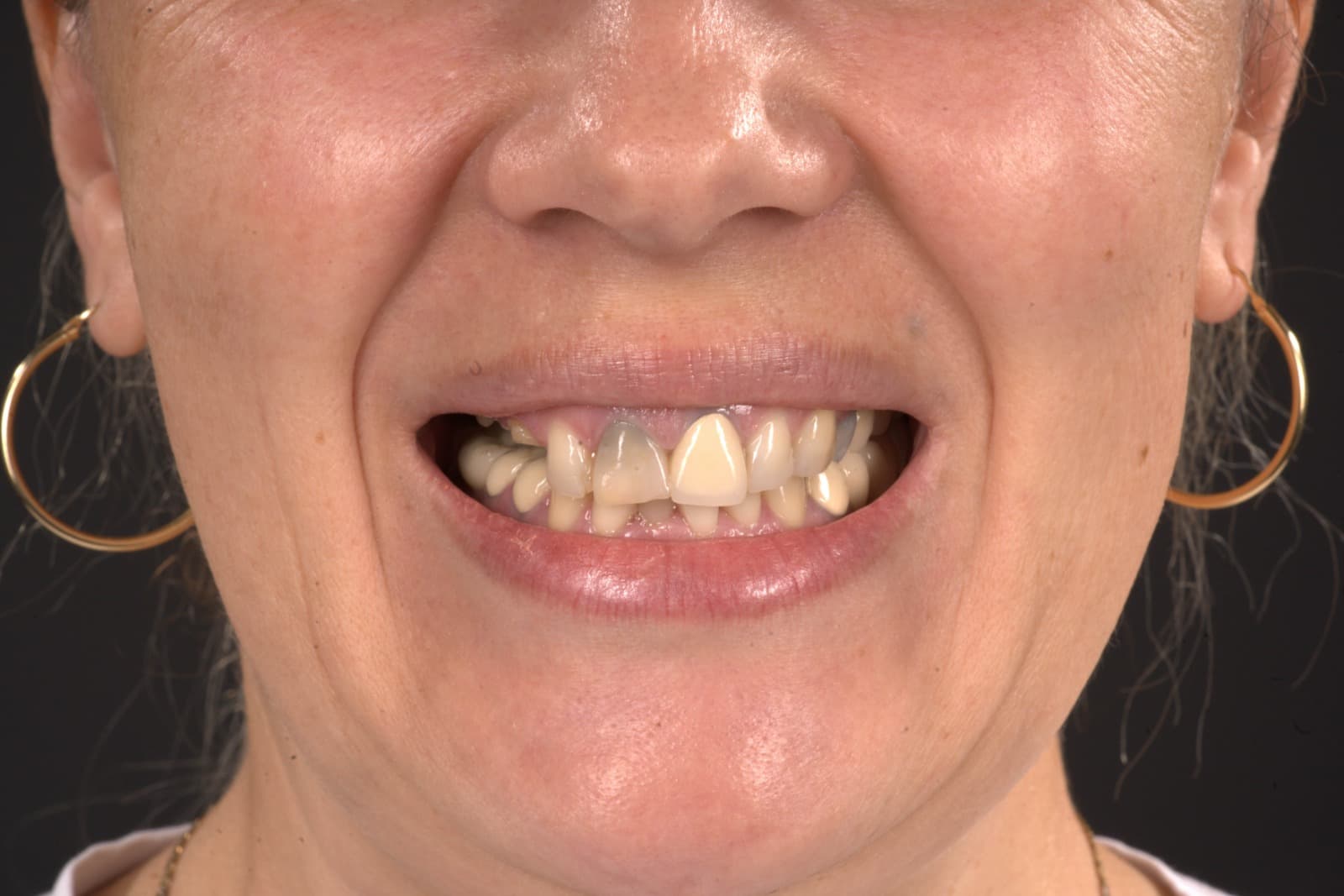 Before - Restoring Health and Hope: A Journey from Pain to Perfection