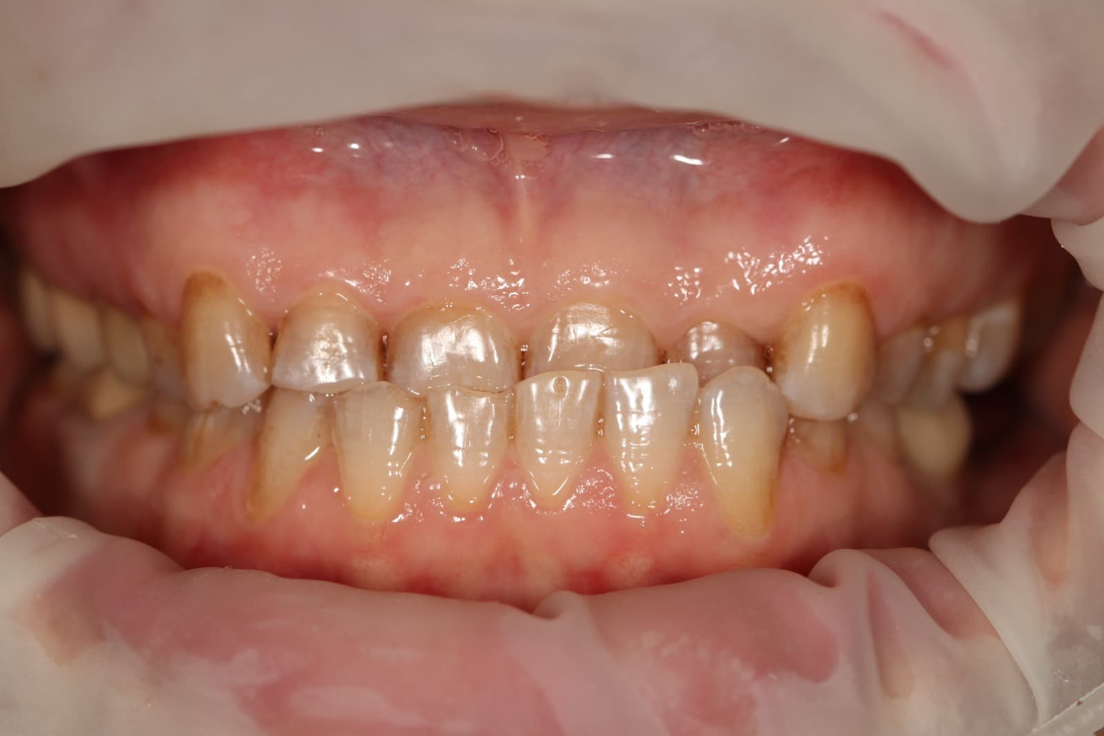 Before - The Rediscovery of a Smile: Overcoming a Lifetime of Wear