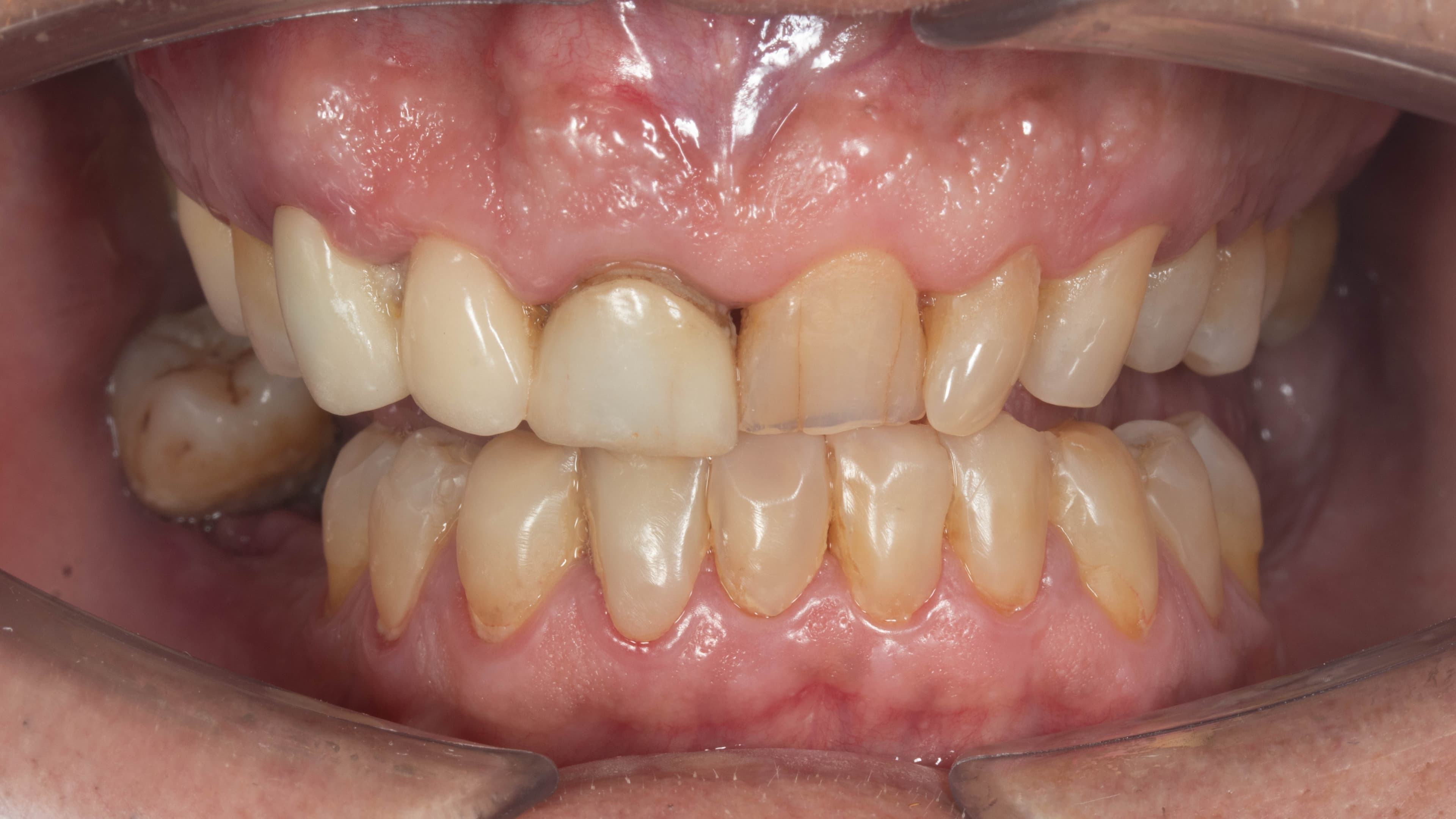 Before - Full-Mouth Rehabilitation with Crowns and Implants