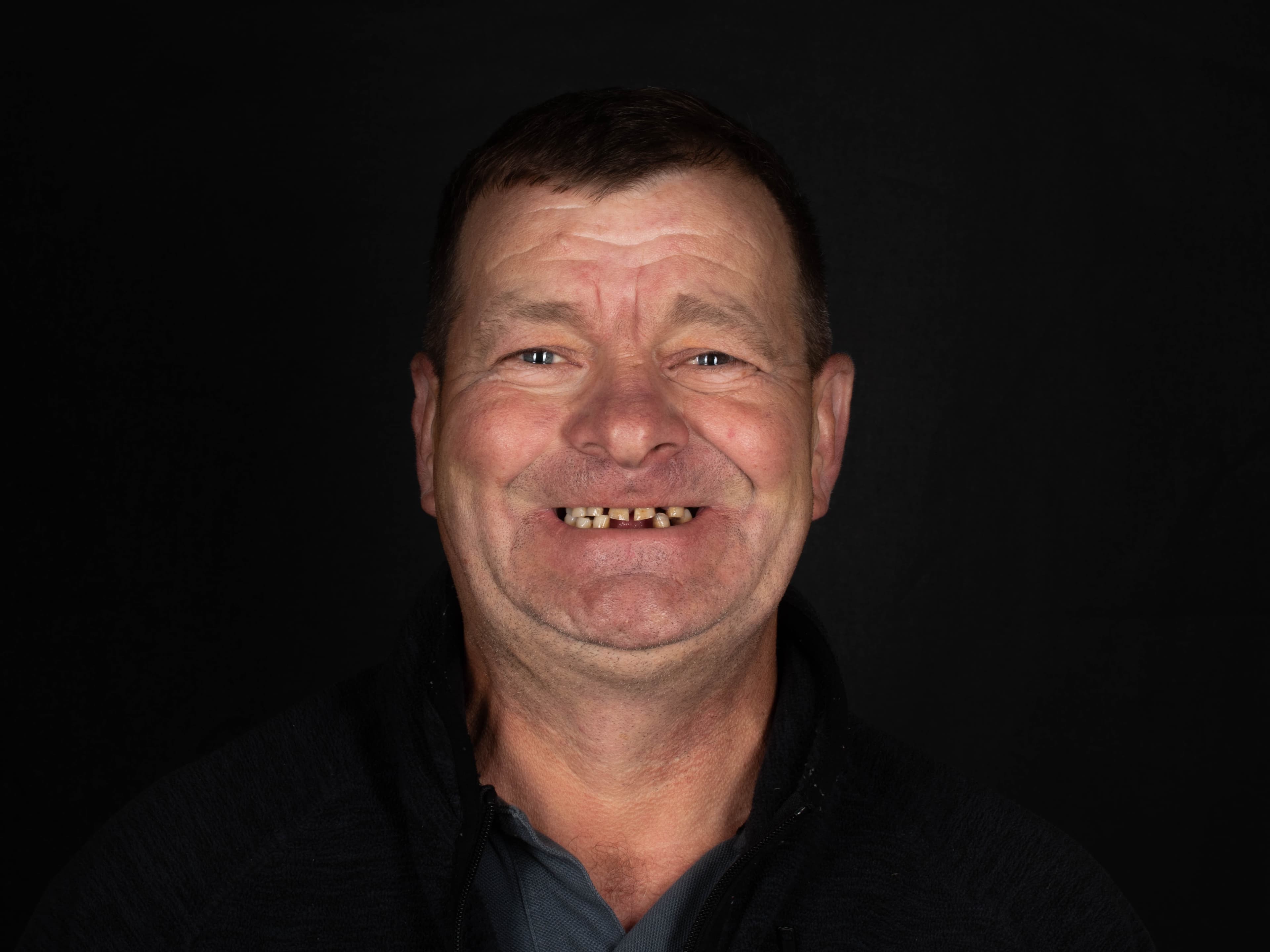 Before - The New Smile, New Life Transformation: Full-Arch Results in Just Days