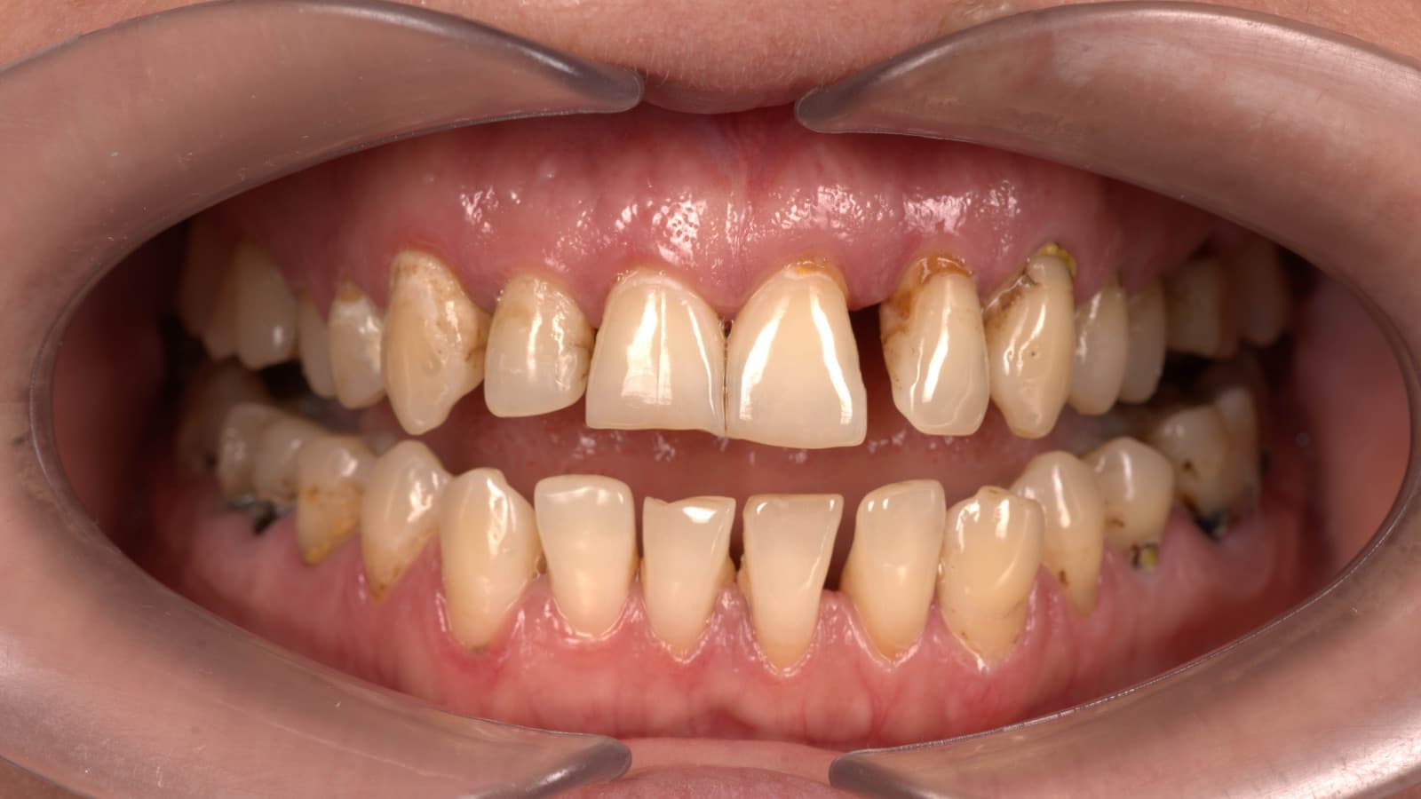 Before - Preserving the Natural Foundation: A Biological Success Story